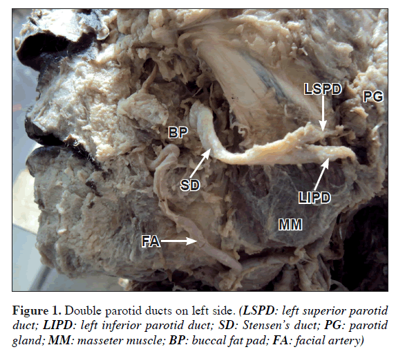 anatomical-variations-Double-parotid