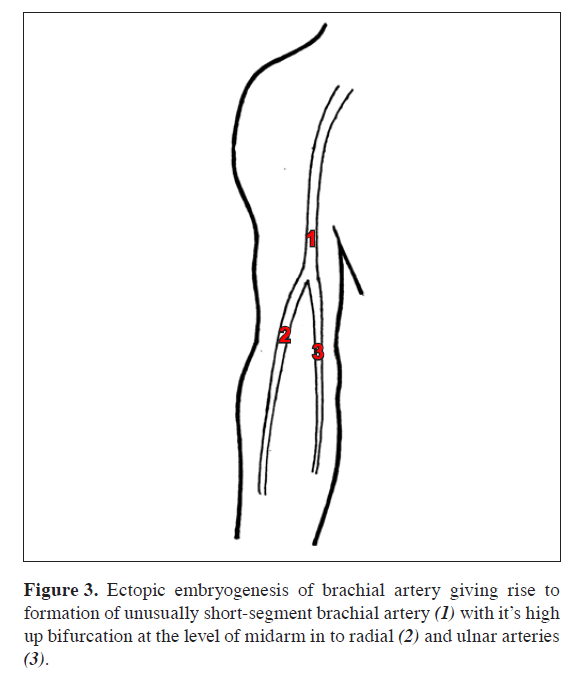 anatomical-variations-Ectopic-embryogenesis