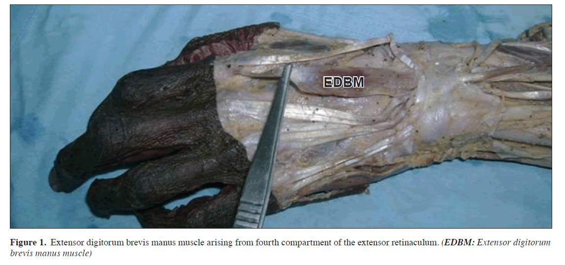 Extensor digitorum brevis manus: Its clinical significance and morphology