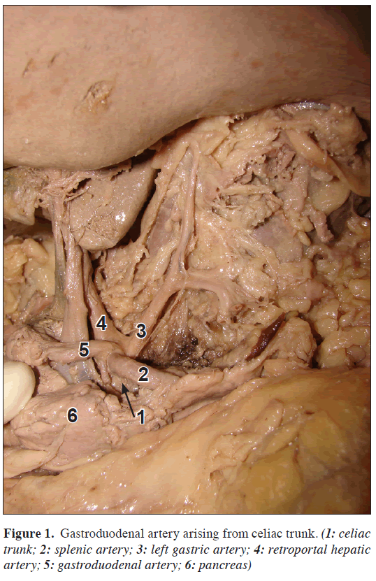 anatomical-variations-Gastroduodenal-artery