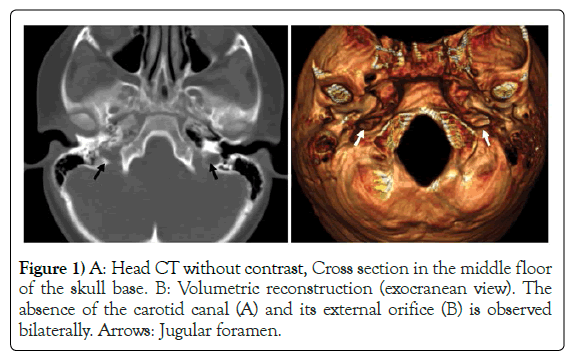 anatomical-variations-Head-CT