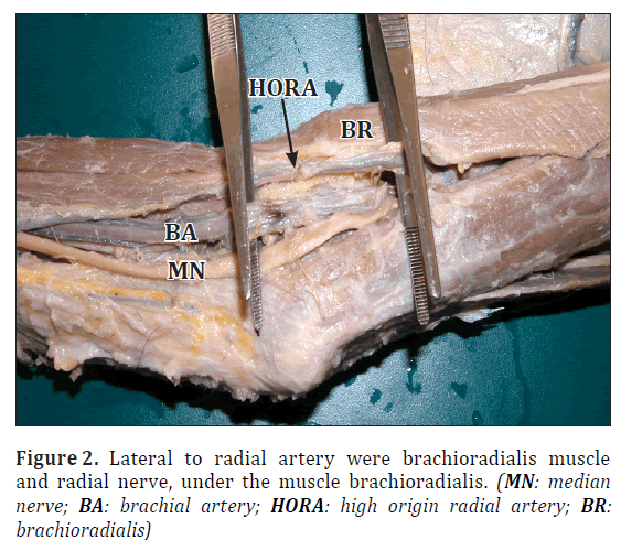 anatomical-variations-Lateral-radial