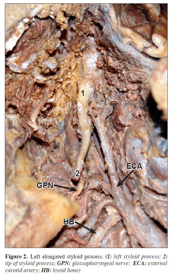 anatomical-variations-Left-elongated