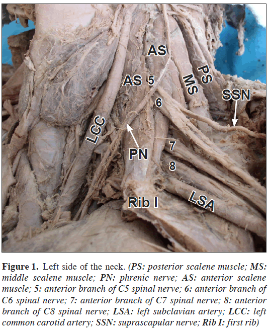 anatomical-variations-Left-side-neck
