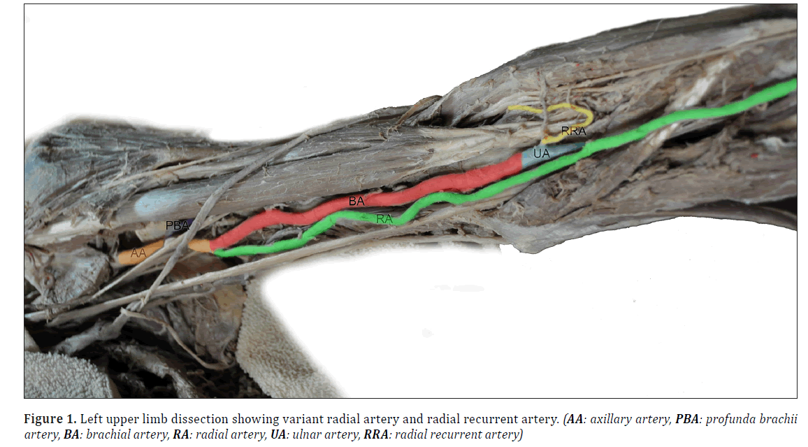 anatomical-variations-Left-upper-limb