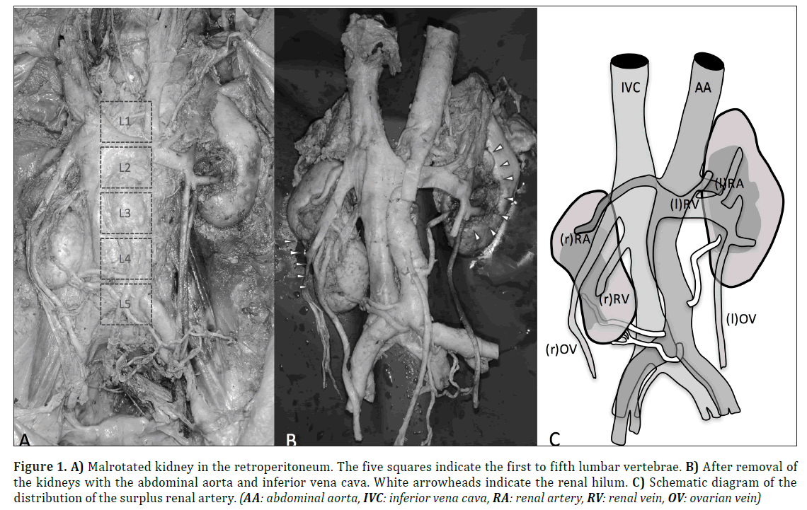 anatomical-variations-Malrotated-kidney