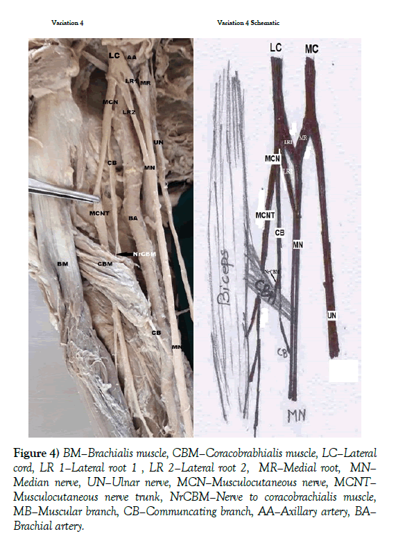 anatomical-variations-Medial-root