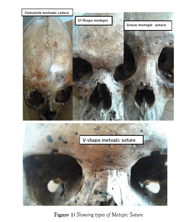 anatomical-variations-Metopic-Suture