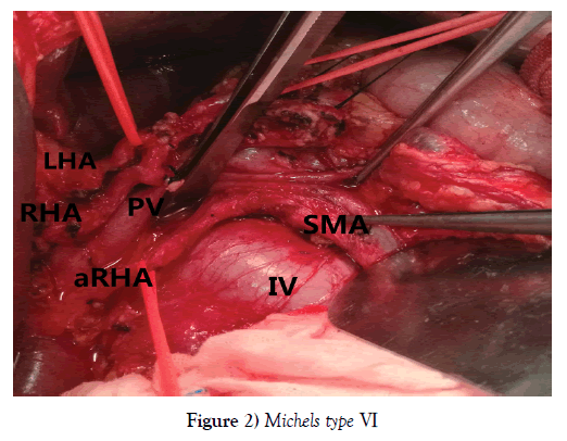 anatomical-variations-Michels