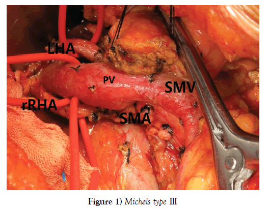 anatomical-variations-Michels-type