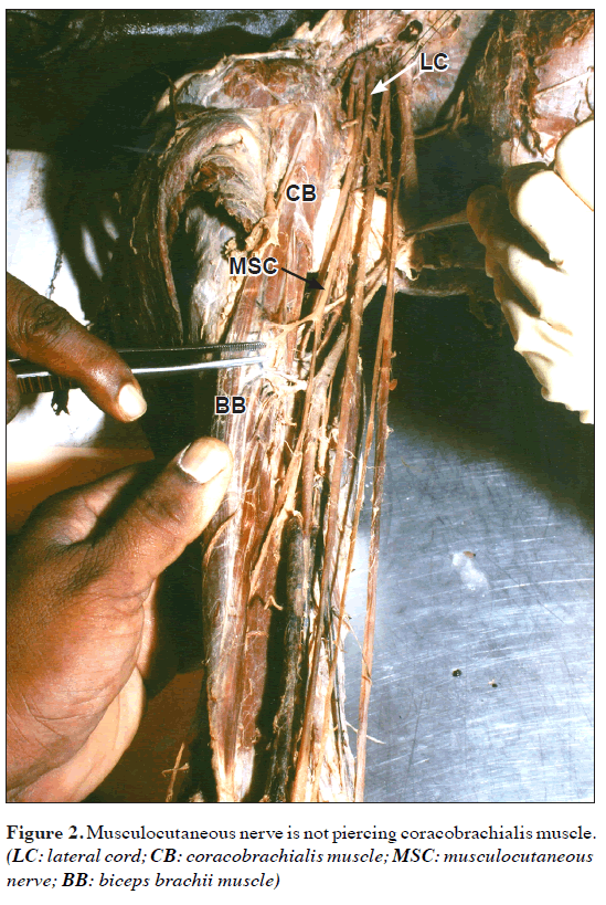 anatomical-variations-Musculocutaneous-nerve