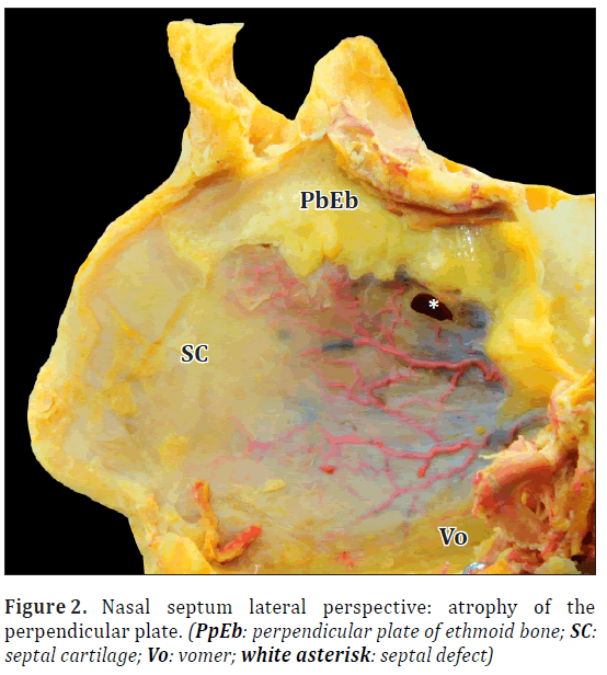 anatomical-variations-Nasal-septum