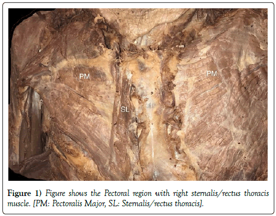 anatomical-variations-Pectoral-region