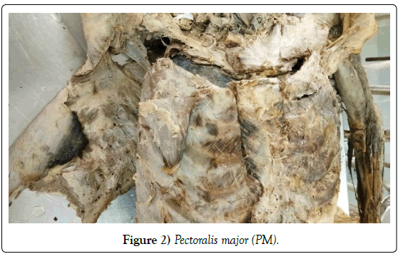 anatomical-variations-Pectoralis-major