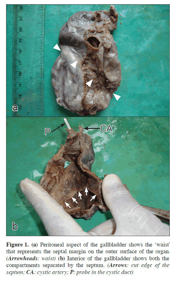 anatomical-variations-Peritoneal-aspect