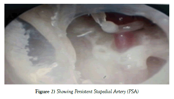 anatomical-variations-Persistent-Stapedial