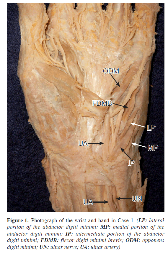 anatomical-variations-Photograph-wrist