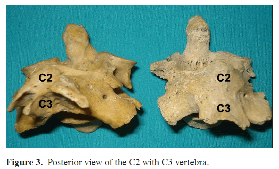 anatomical-variations-Posterior-view