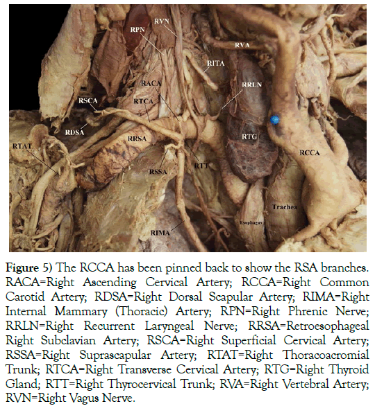 anatomical-variations-RSA-branches