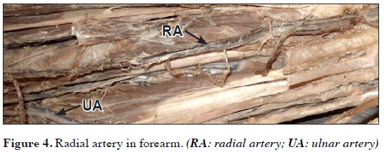 Unusual origin of the radial artery