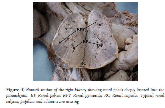 anatomical-variations-Renal-pyramids