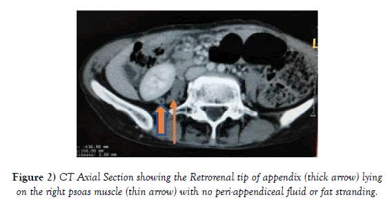 anatomical-variations-Retrorenal-tip