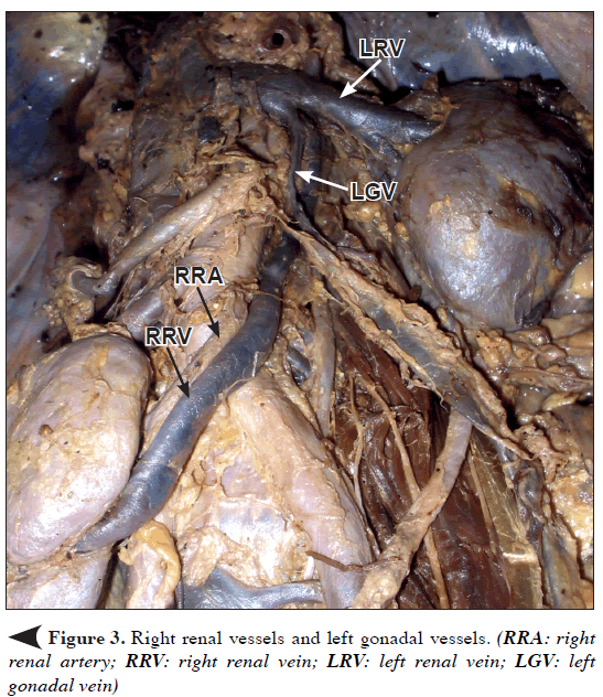 anatomical-variations-Right-renal-vessels