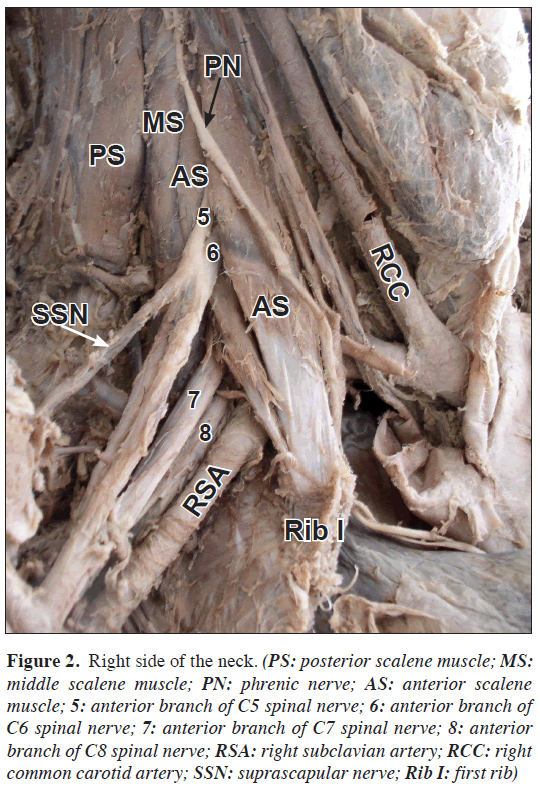 anatomical-variations-Right-side-neck