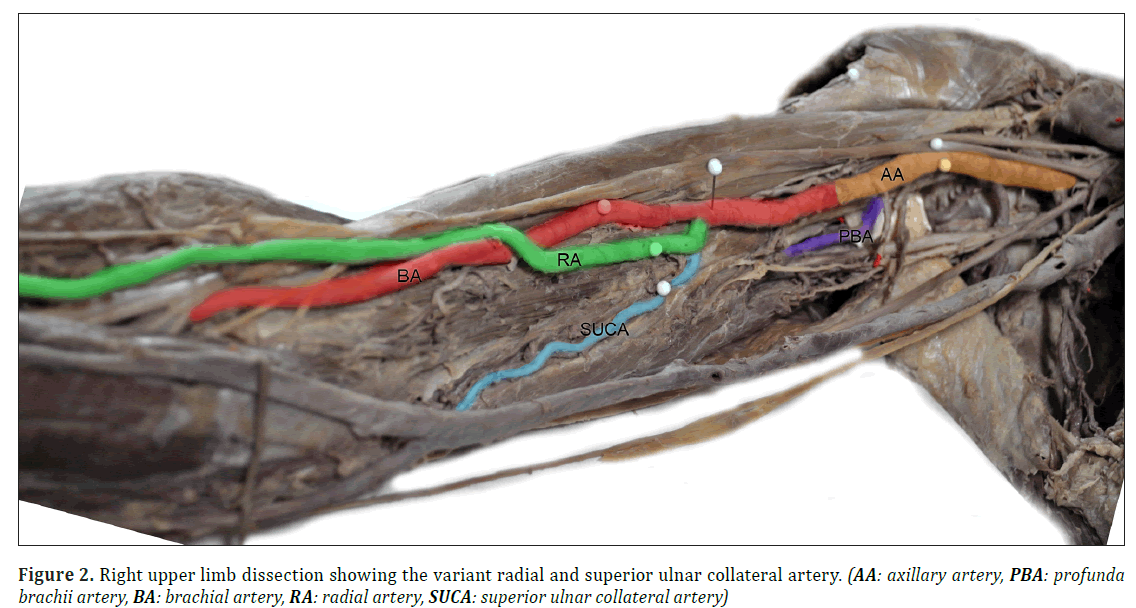 anatomical-variations-Right-upper-limb