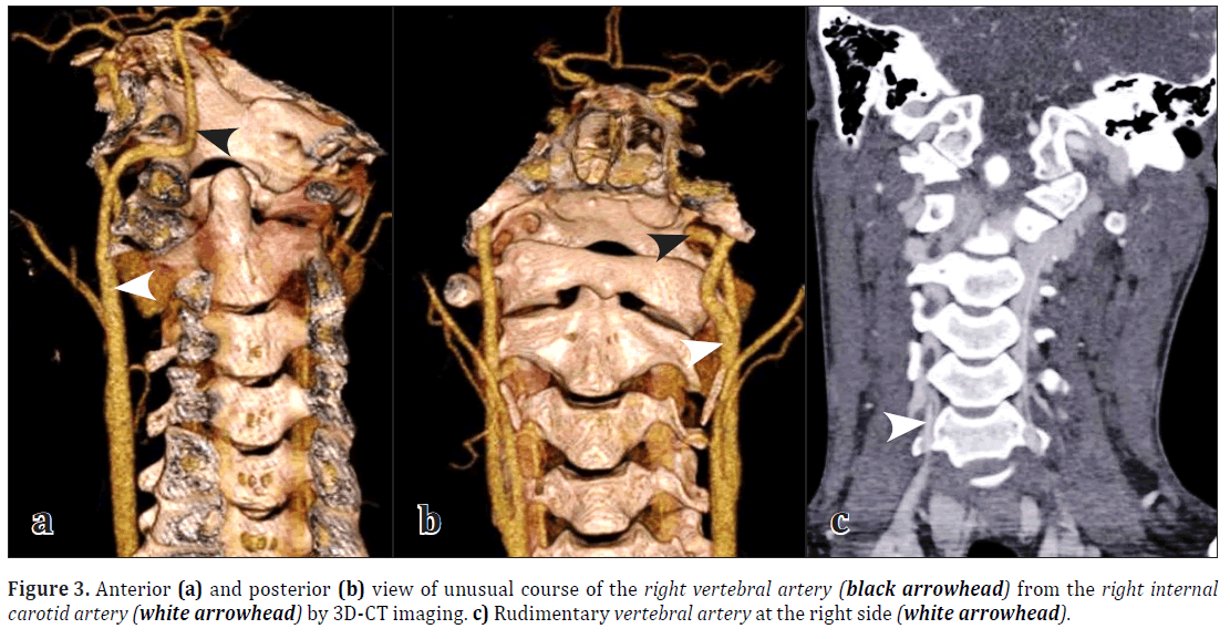 anatomical-variations-Rudimentary-vertebral