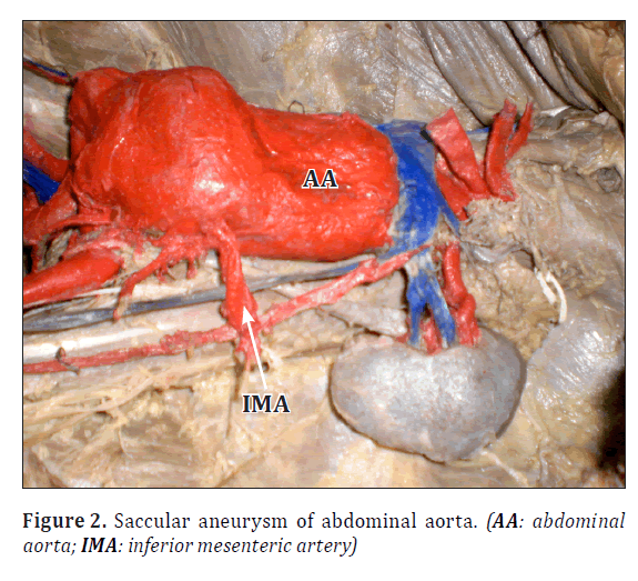anatomical-variations-Saccular-aneurysm