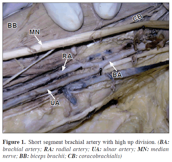 anatomical-variations-Short-segment