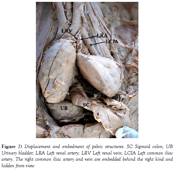 anatomical-variations-Sigmoid-colon