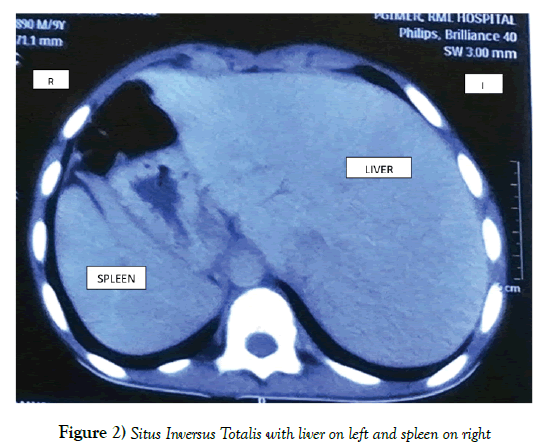 anatomical-variations-Situs-Inversus