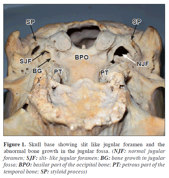 anatomical-variations-Skull-base