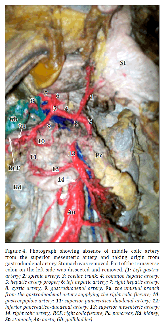 anatomical-variations-Stomach-removed