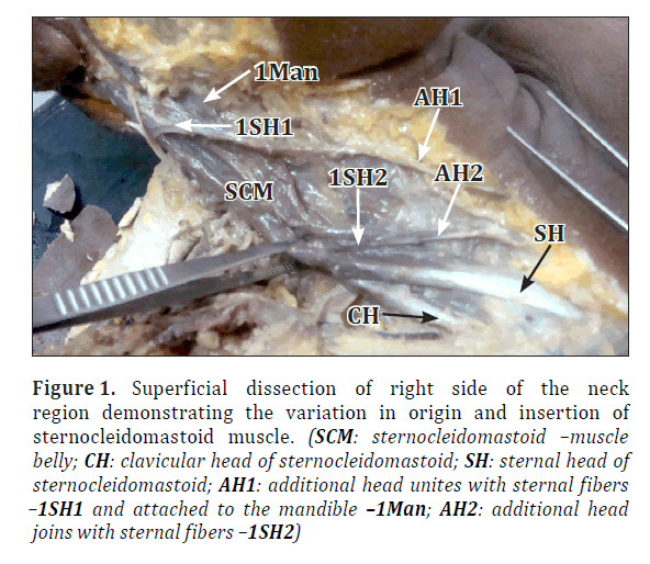 anatomical-variations-Superficial-dissection