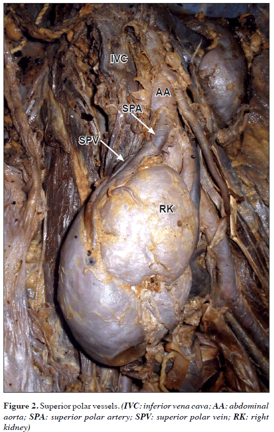 anatomical-variations-Superior-polar-vessels