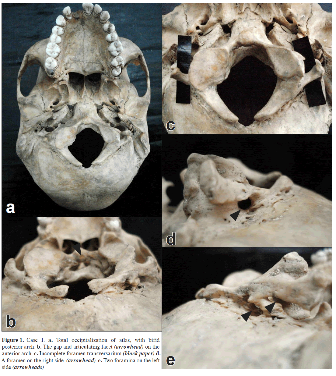 anatomical-variations-Total-occipitalization