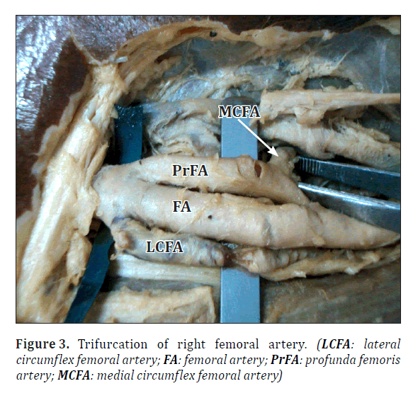 anatomical-variations-Trifurcation-right