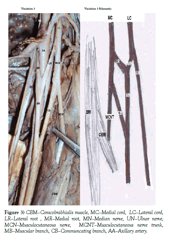 anatomical-variations-Ulnar-nerve