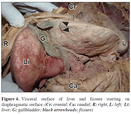 anatomical-variations-Visceral-surface