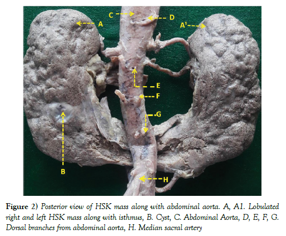 anatomical-variations-abdominal-aorta