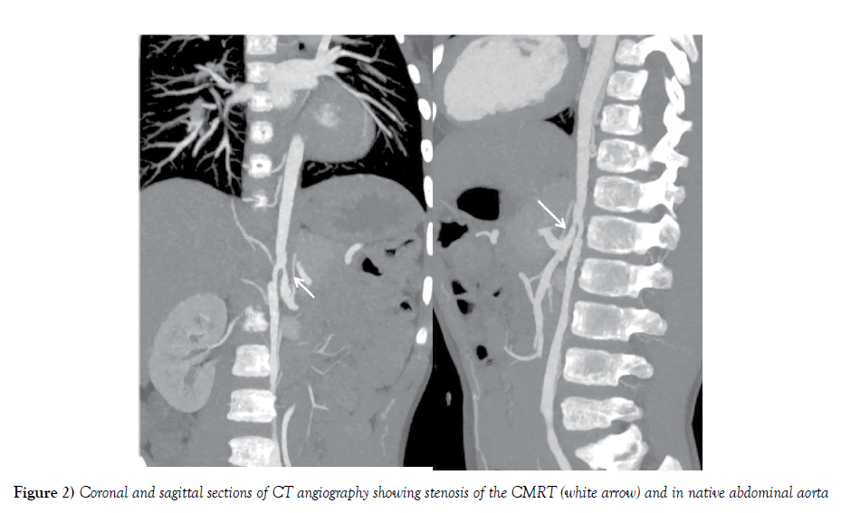 anatomical-variations-abdominal-aorta