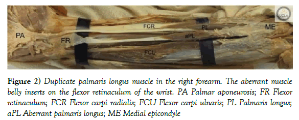 anatomical-variations-aberrant-muscle