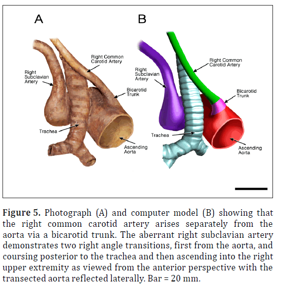 anatomical-variations-aberrant-right