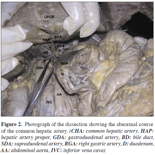 anatomical-variations-abnormal-course