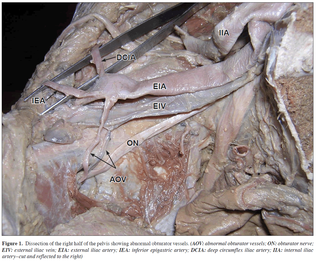 anatomical-variations-abnormal-obturator