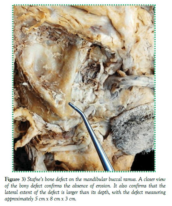 anatomical-variations-absence-erosion