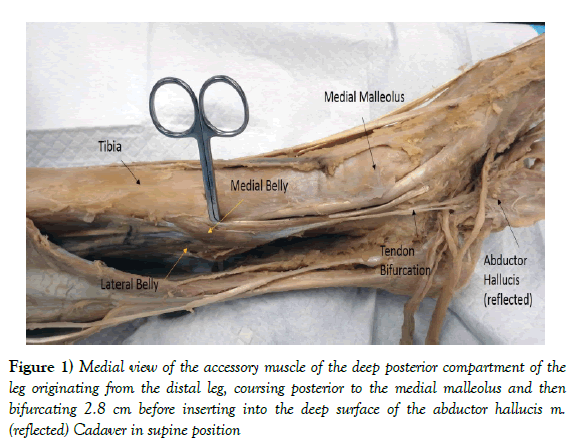 anatomical-variations-accessory-muscle